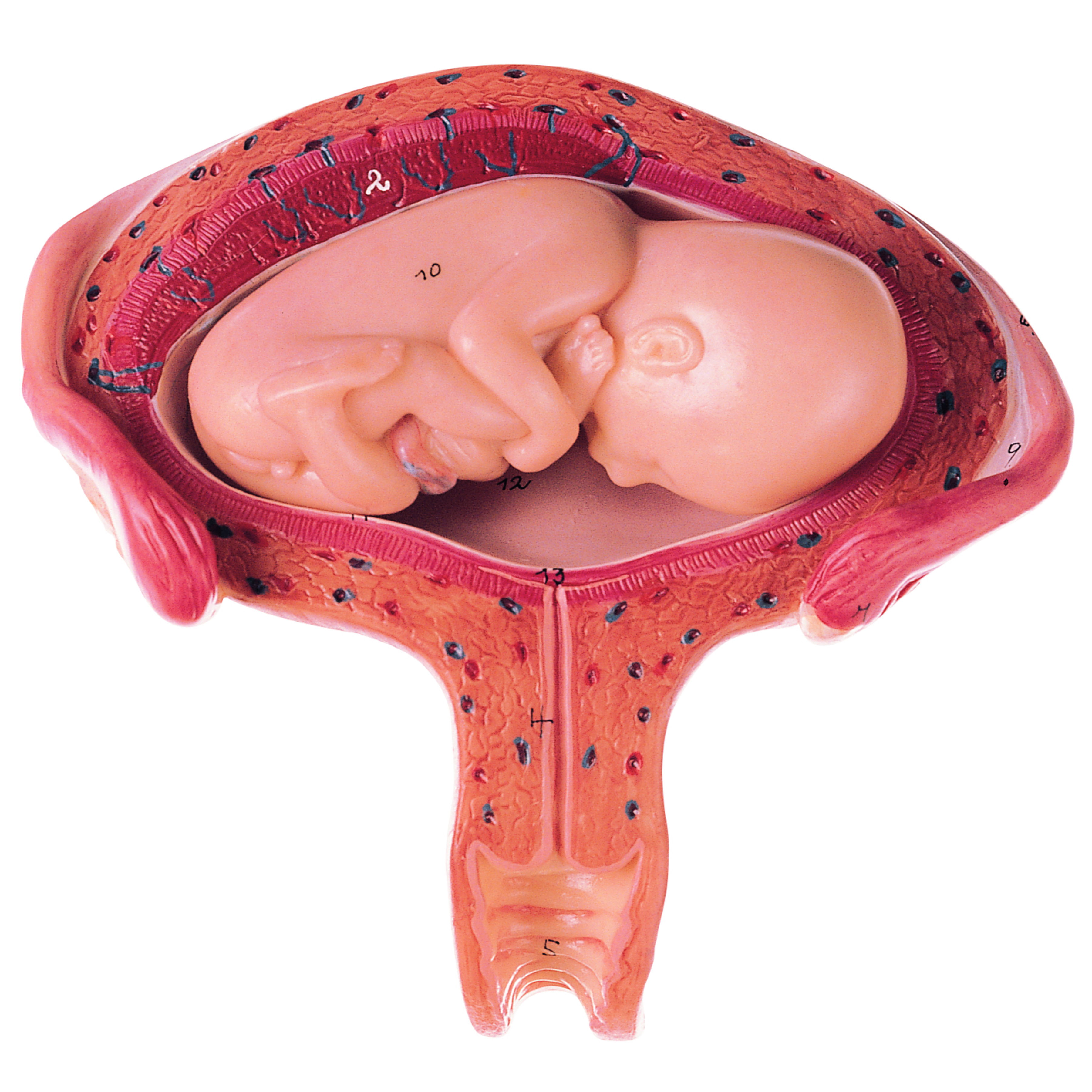 Uterus With Fetus in Fourth to Fifth Month