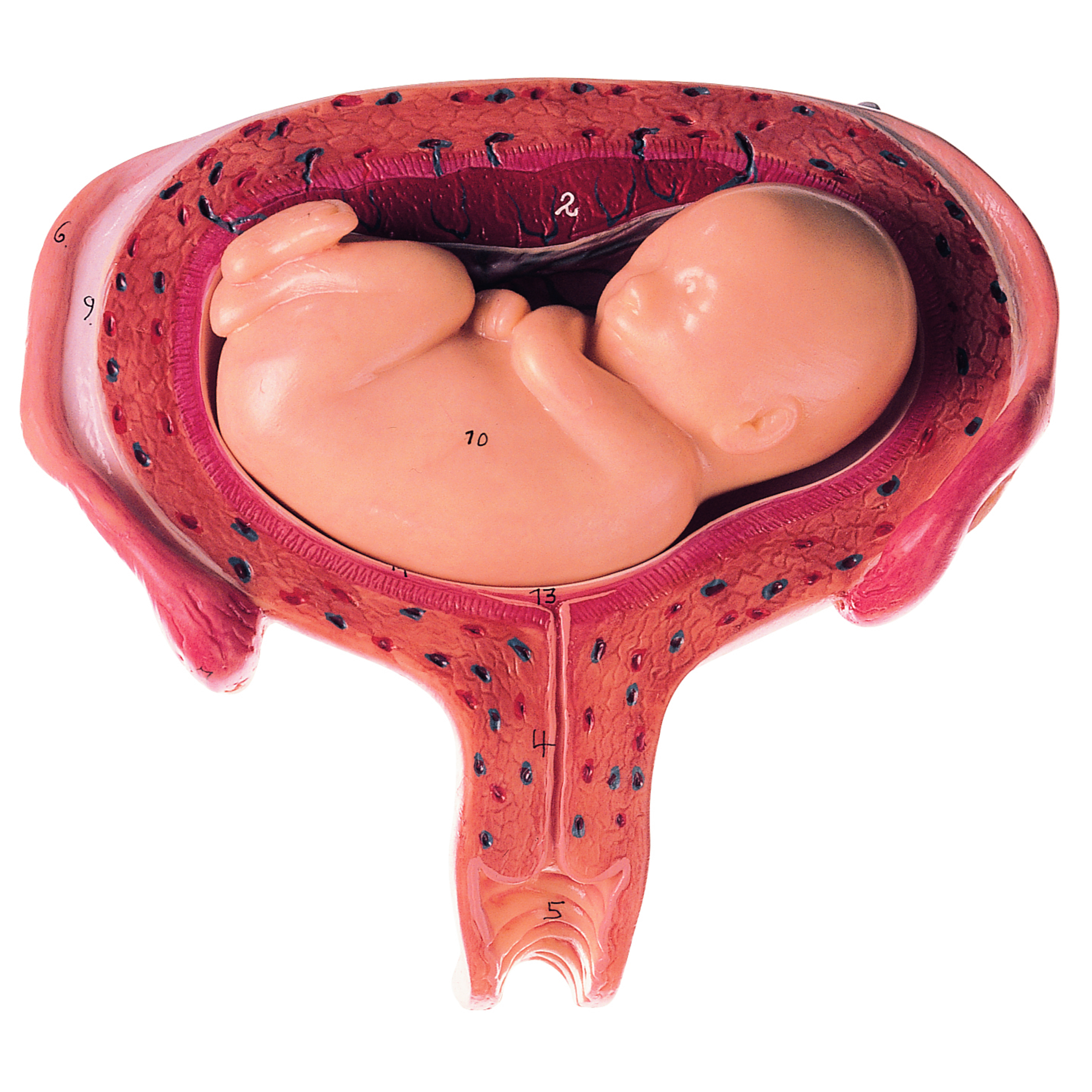 Uterus With Fetus in Fifth Month