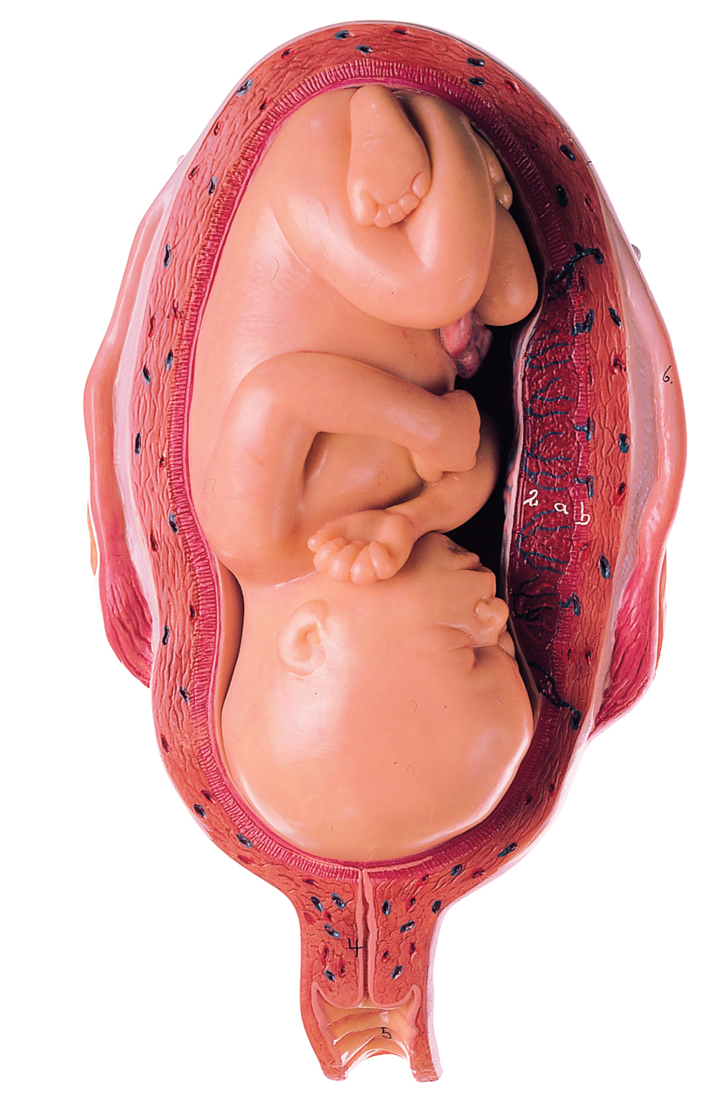 Uterus With Fetus in Seventh Month