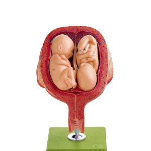 Uterus With Twin Fetus in Fifth Month