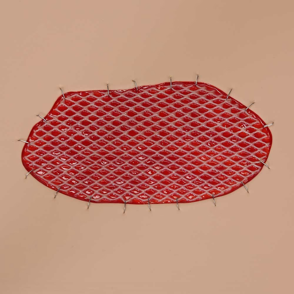Skin Graft Wound Board, Light