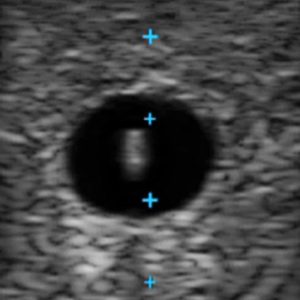 Vascular Access Ultrasound Phantom - 4 Vein Bifurcated With Deep Vein, Light