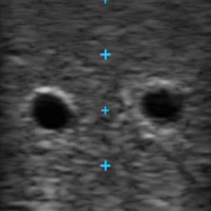 Vascular Access Ultrasound Phantom - 4 Vein Bifurcated With Deep Vein, Light