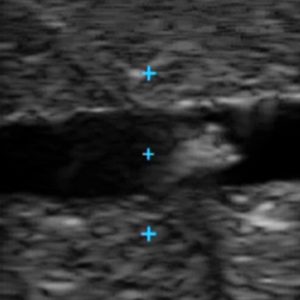 Vascular Access Ultrasound Phantom - 4 Vein Bifurcated With Deep Vein, Light