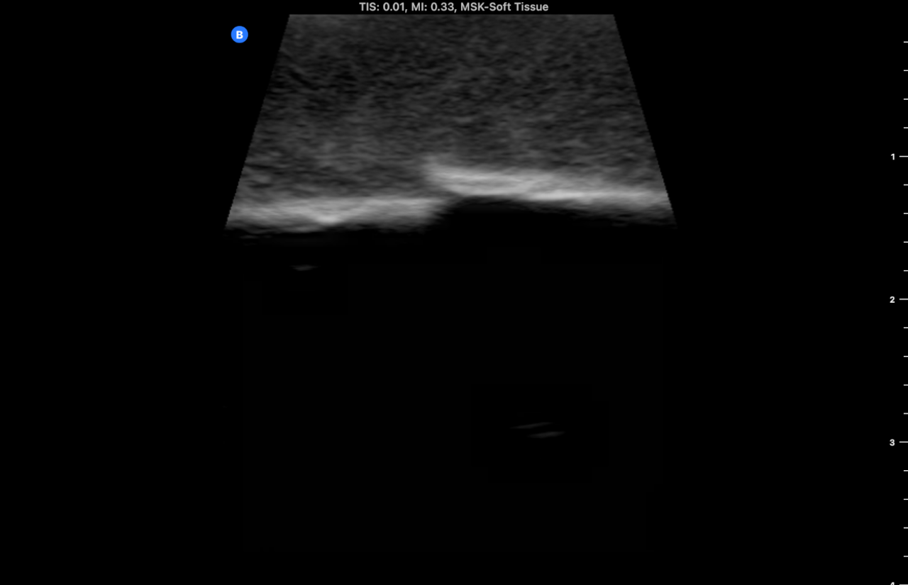 Ultrasound Phantom - Bone Fracture, Light