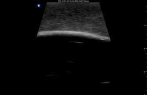 Ultrasound Phantom - Bone Fracture, Light