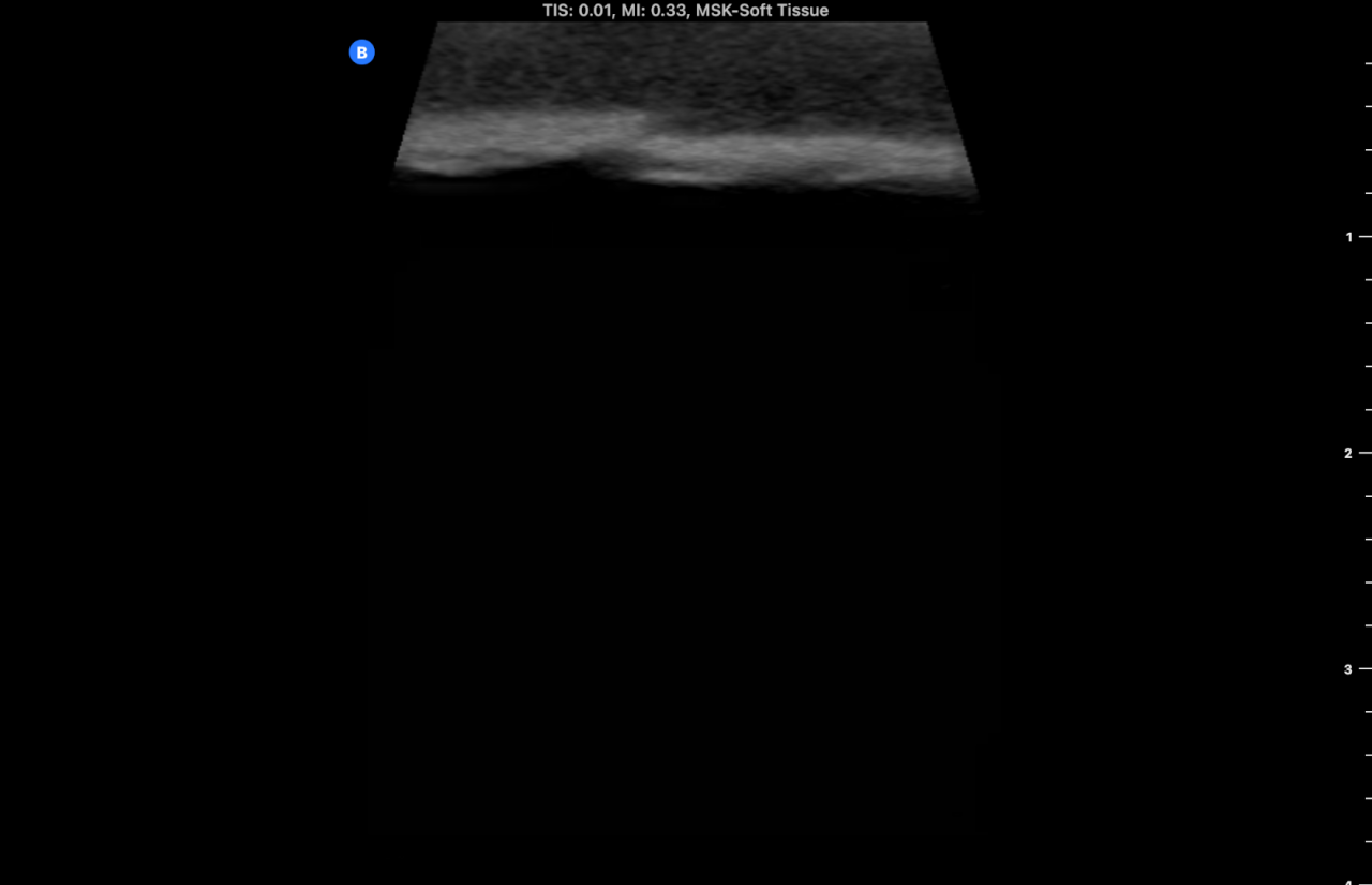 Ultrasound Phantom - Bone Fracture, Light