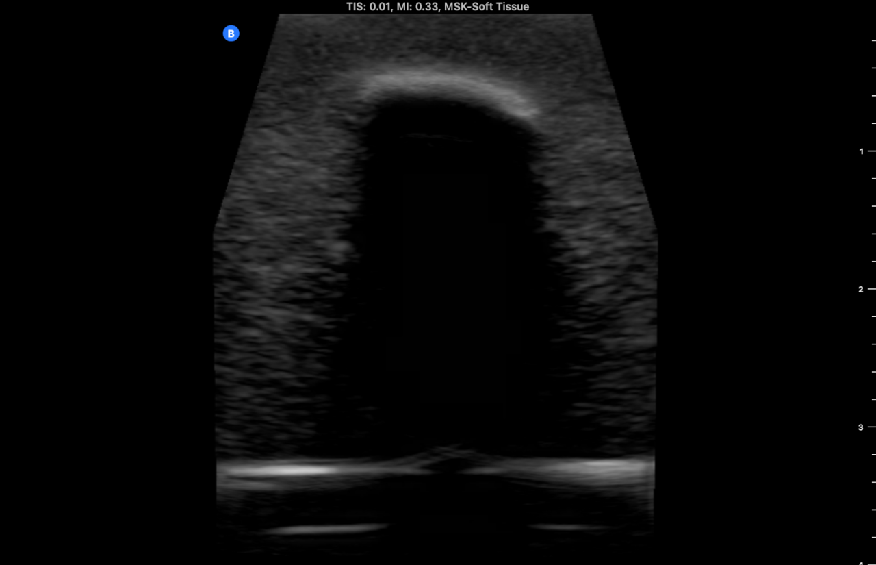 Ultrasound Phantom - Bone Fracture, Light