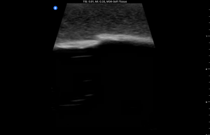 Ultrasound Phantom, Bone Fracture, Dark