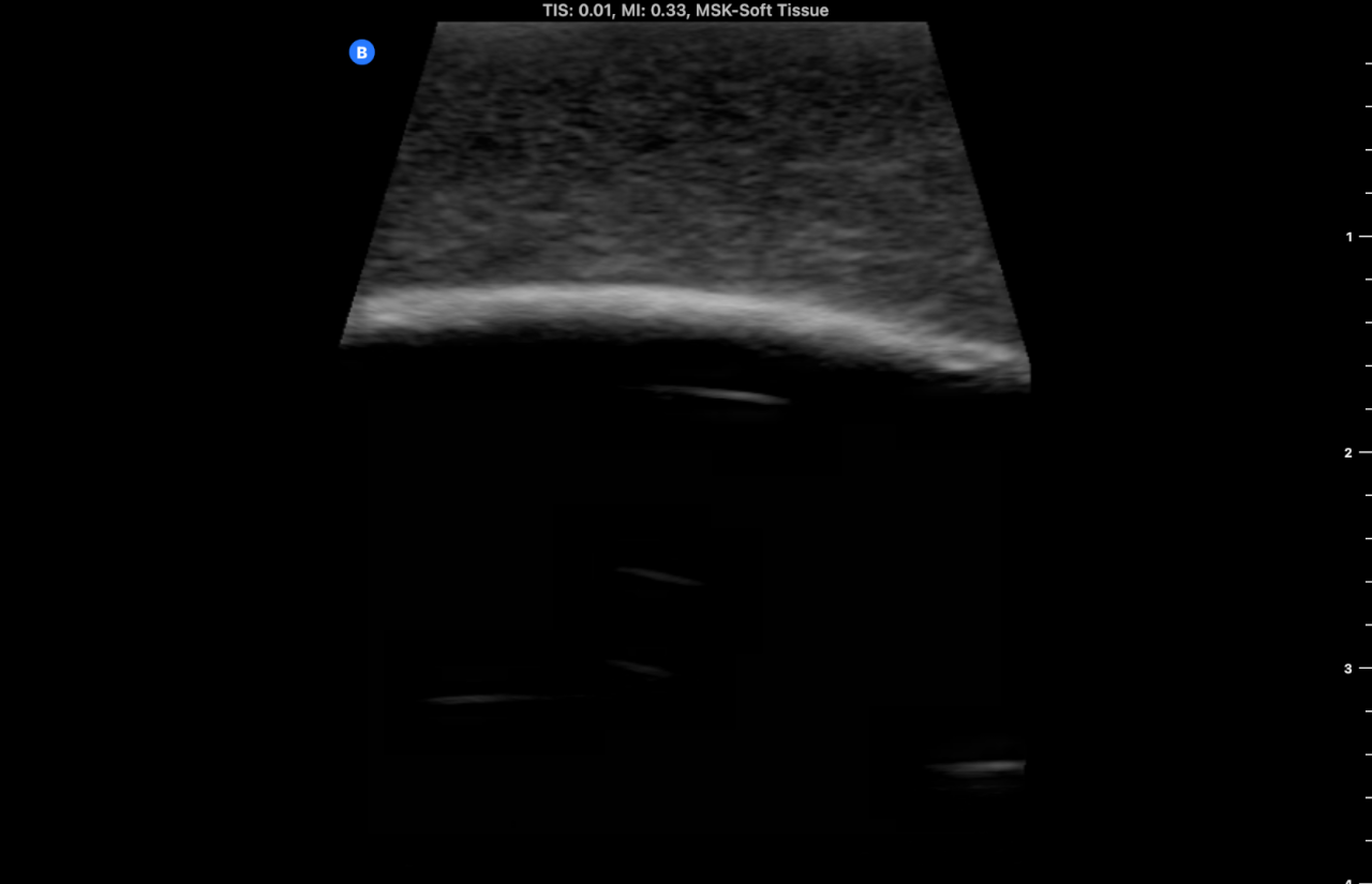 Ultrasound Phantom, Bone Fracture, Dark