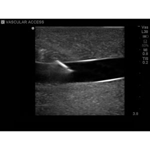 Tissue Insert For Gen I Central Venous Access, With Hand Pump