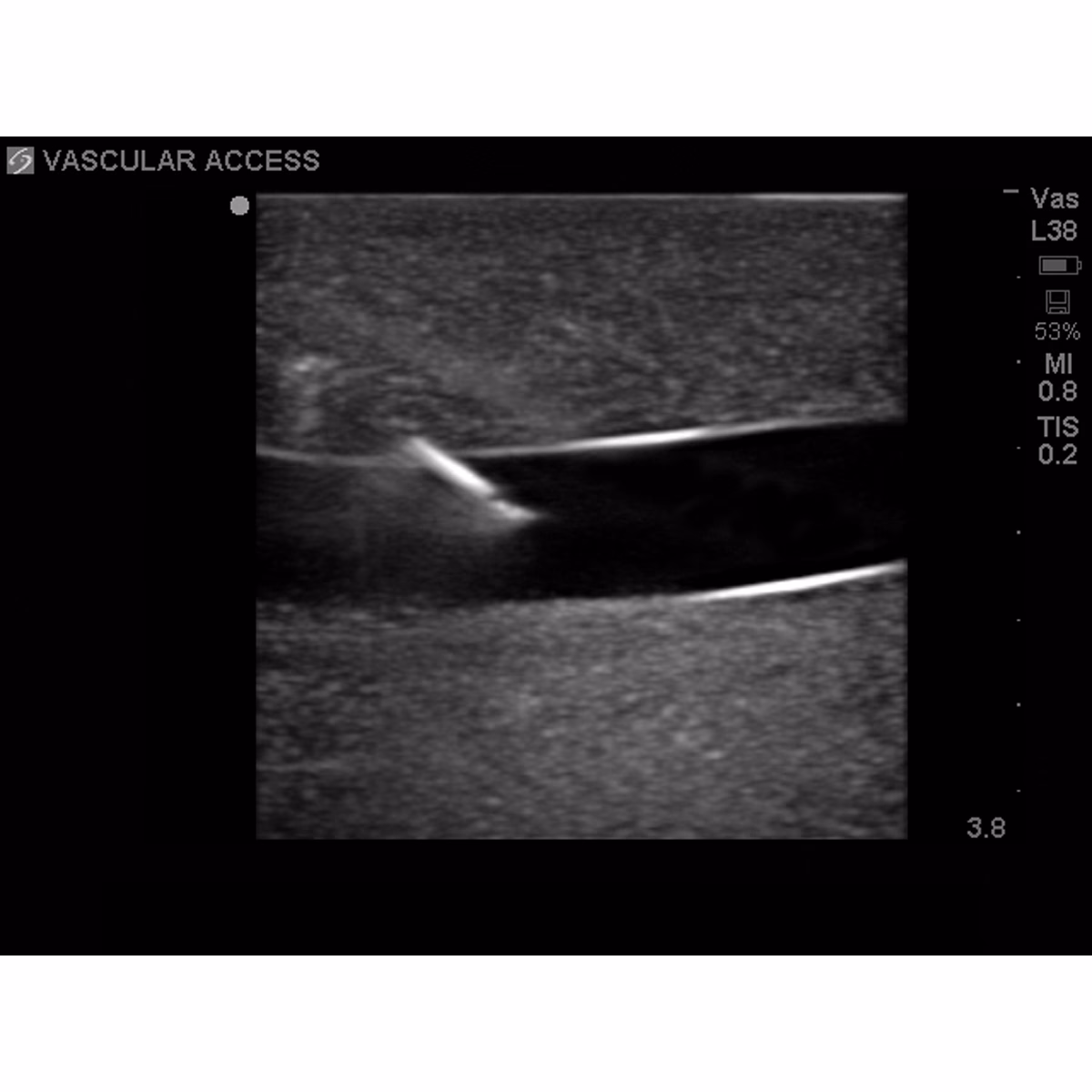 Tissue Insert For Gen I Central Venous Access, With Hand Pump