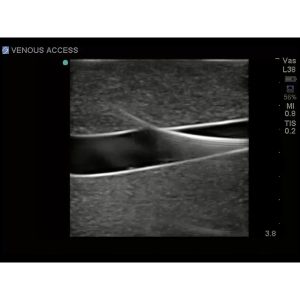 Tissue Insert For Gen I Central Venous Access, With Hand Pump