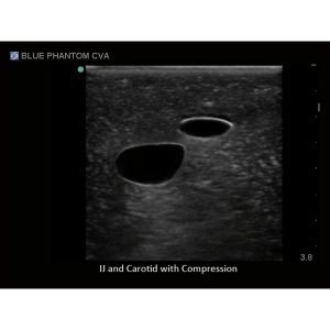 Tissue Insert For Gen I Central Venous Access, With Hand Pump