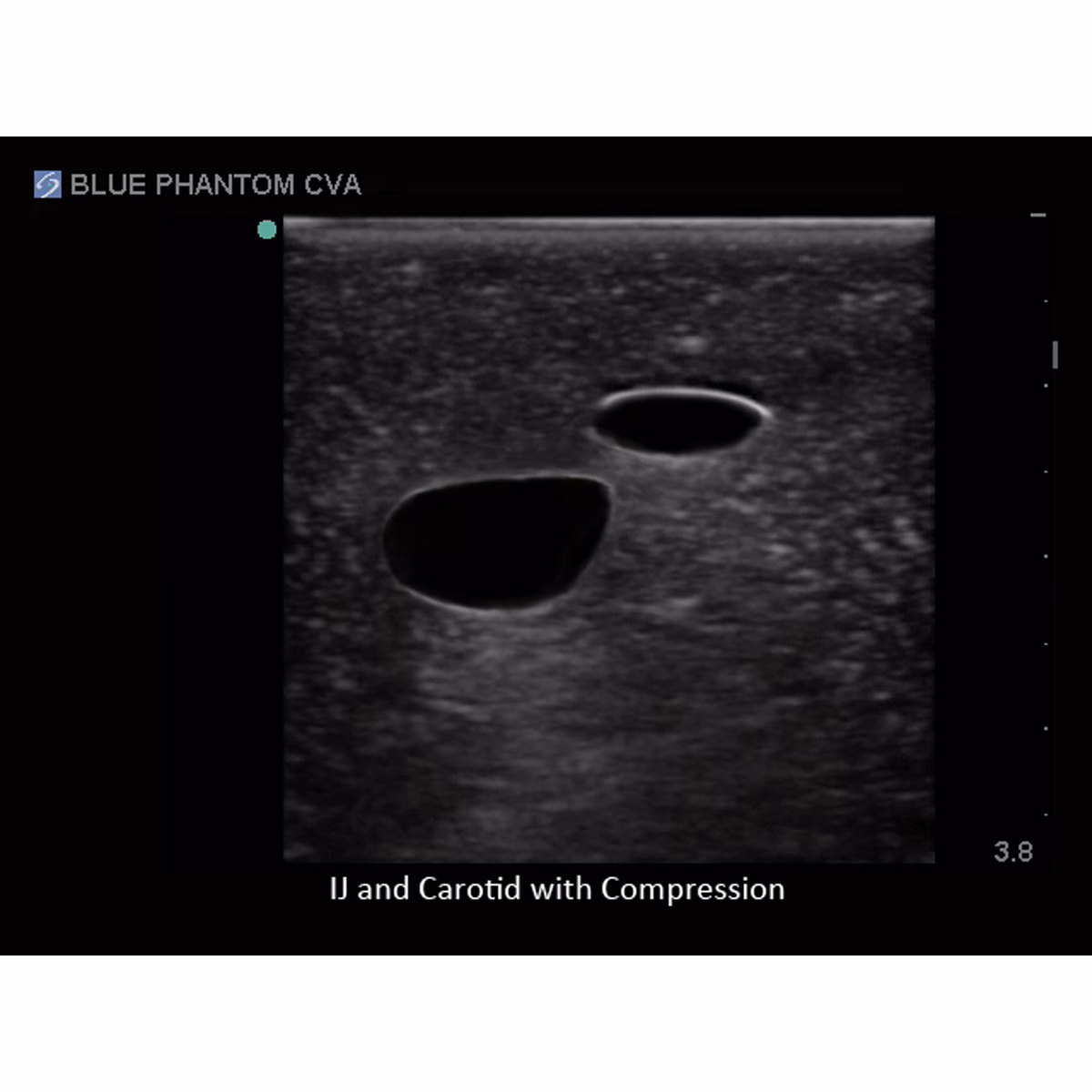 Tissue Insert For Gen I Central Venous Access, With Hand Pump