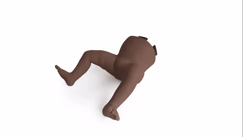 Infant Hip Exam – Lower Abnormal, Dark