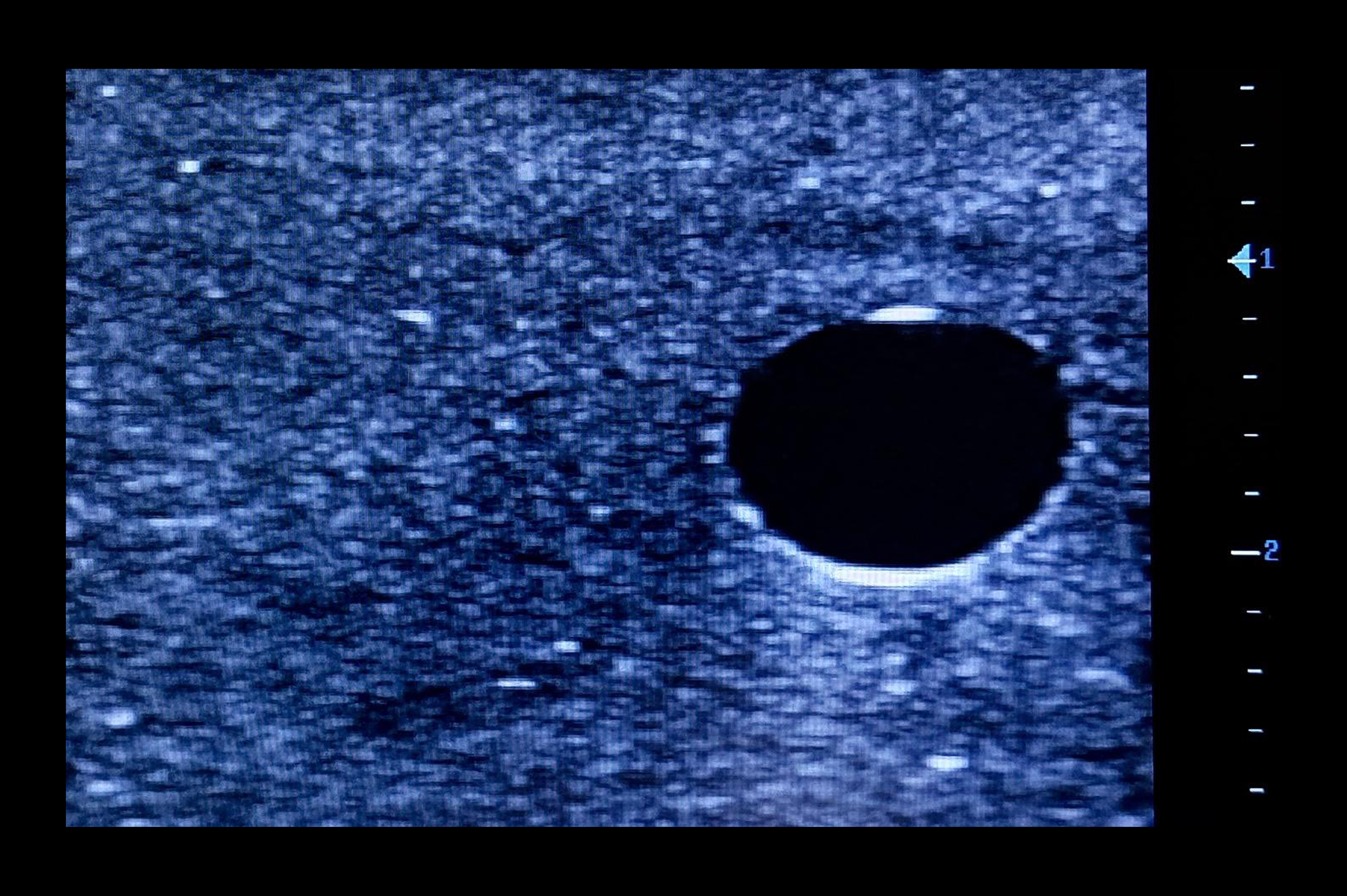 Ultrasound Simulator with 2 Peripheral Veins, Light