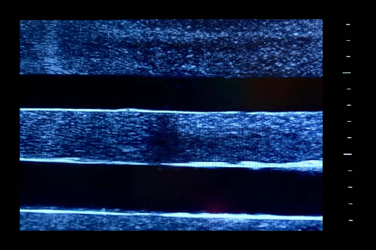 Ultrasound Simulator with 4 Central Lines, Light