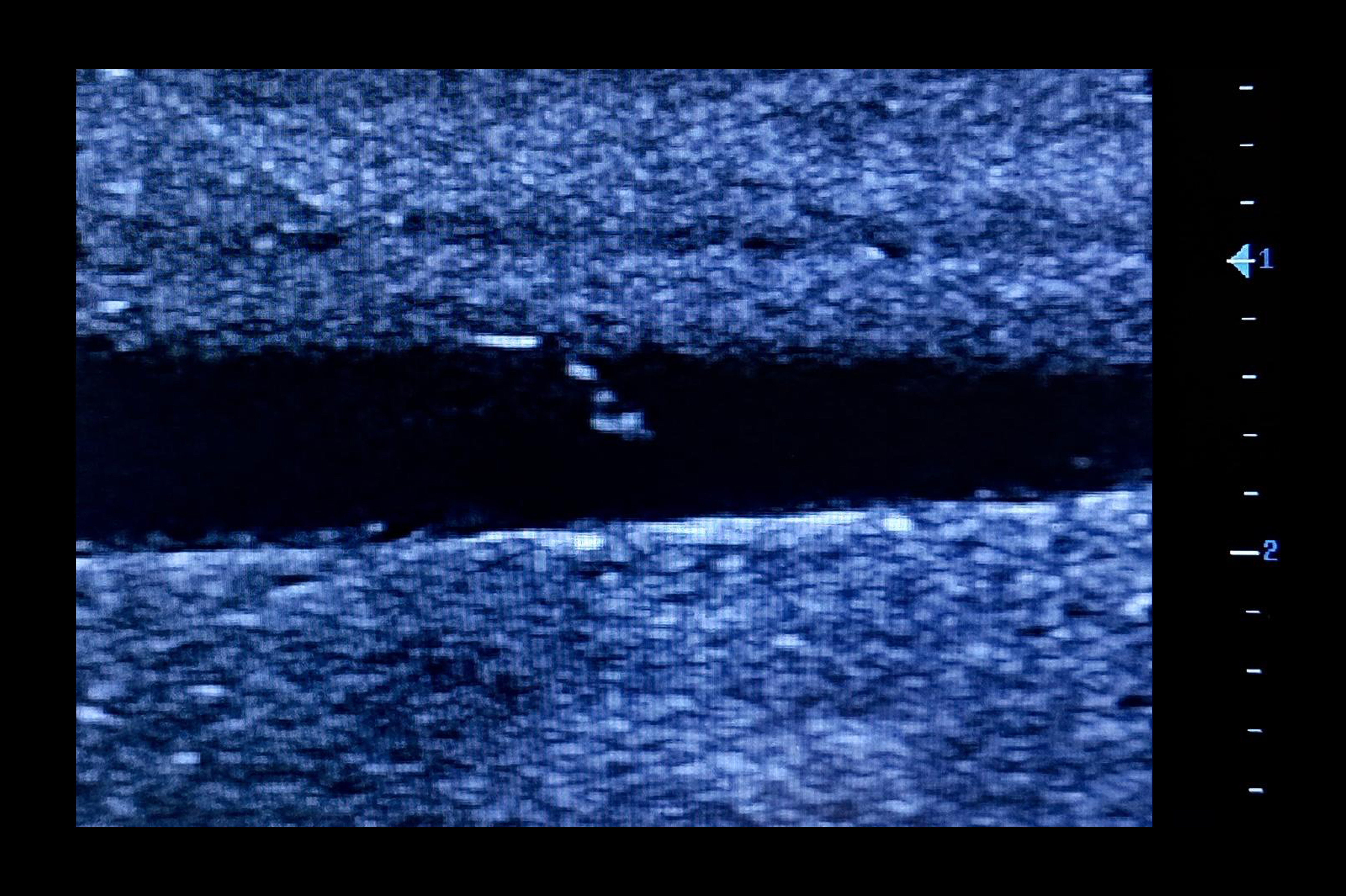 Ultrasound Simulator for Seldinger Technique, Light