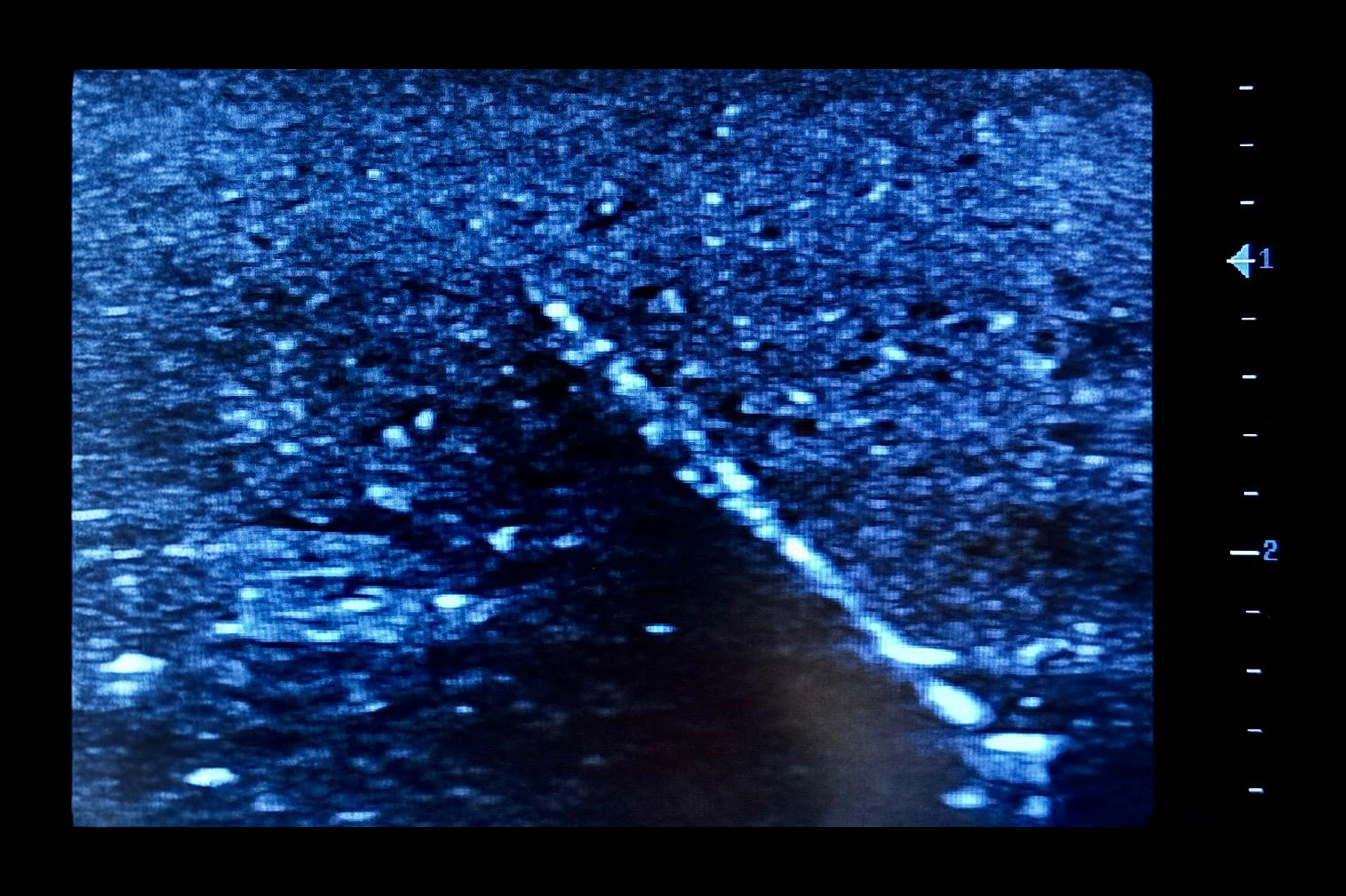 Ultrasound Simulator with Foreign Bodies, Dark