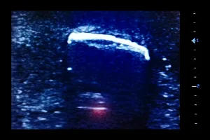 Ultrasound Simulator with Foreign Bodies, Dark