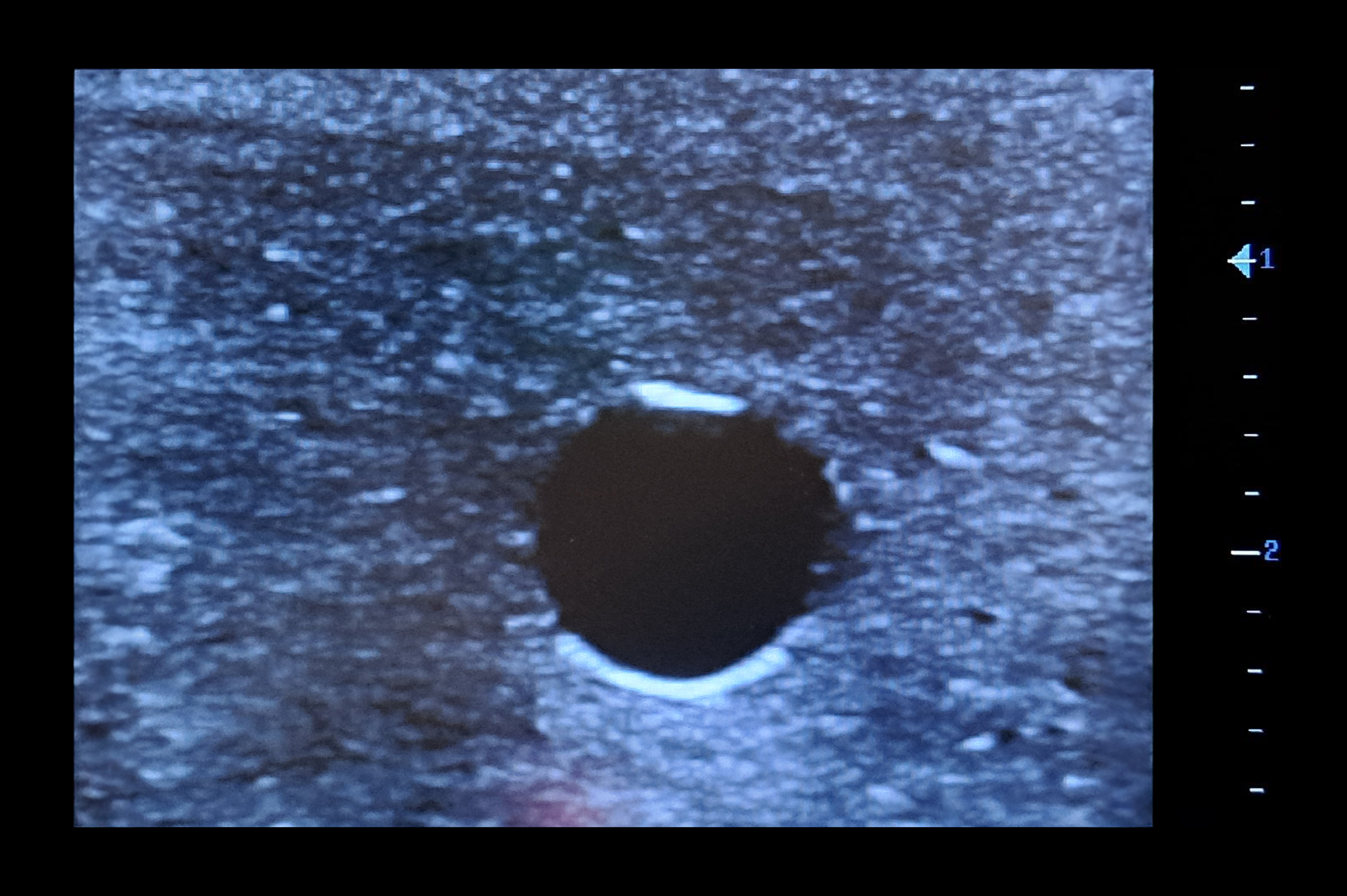 Central Access Ultrasound Simulator with Aneurysms, Light