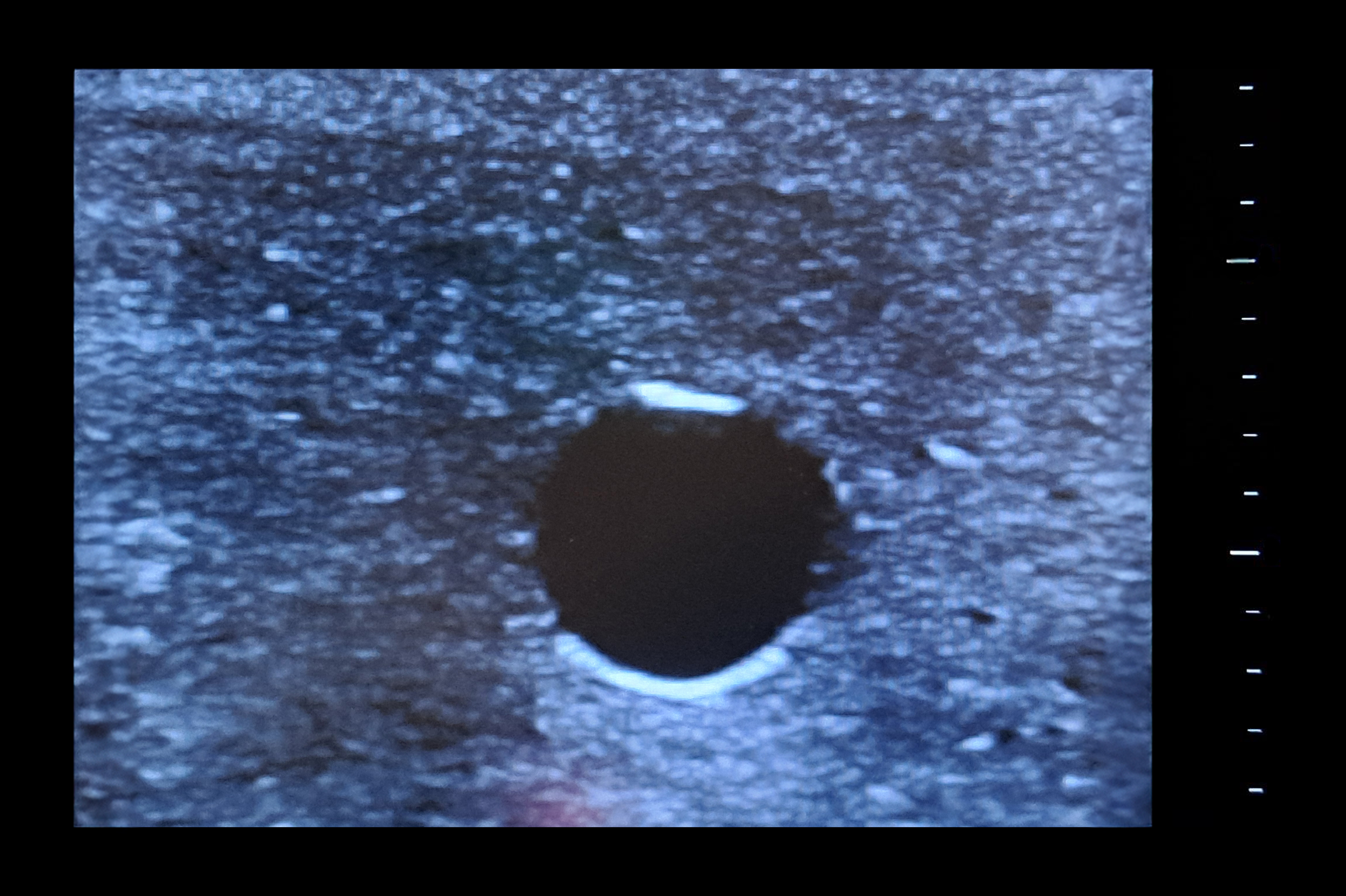 Central Access Ultrasound Simulator with Aneurysms, Dark