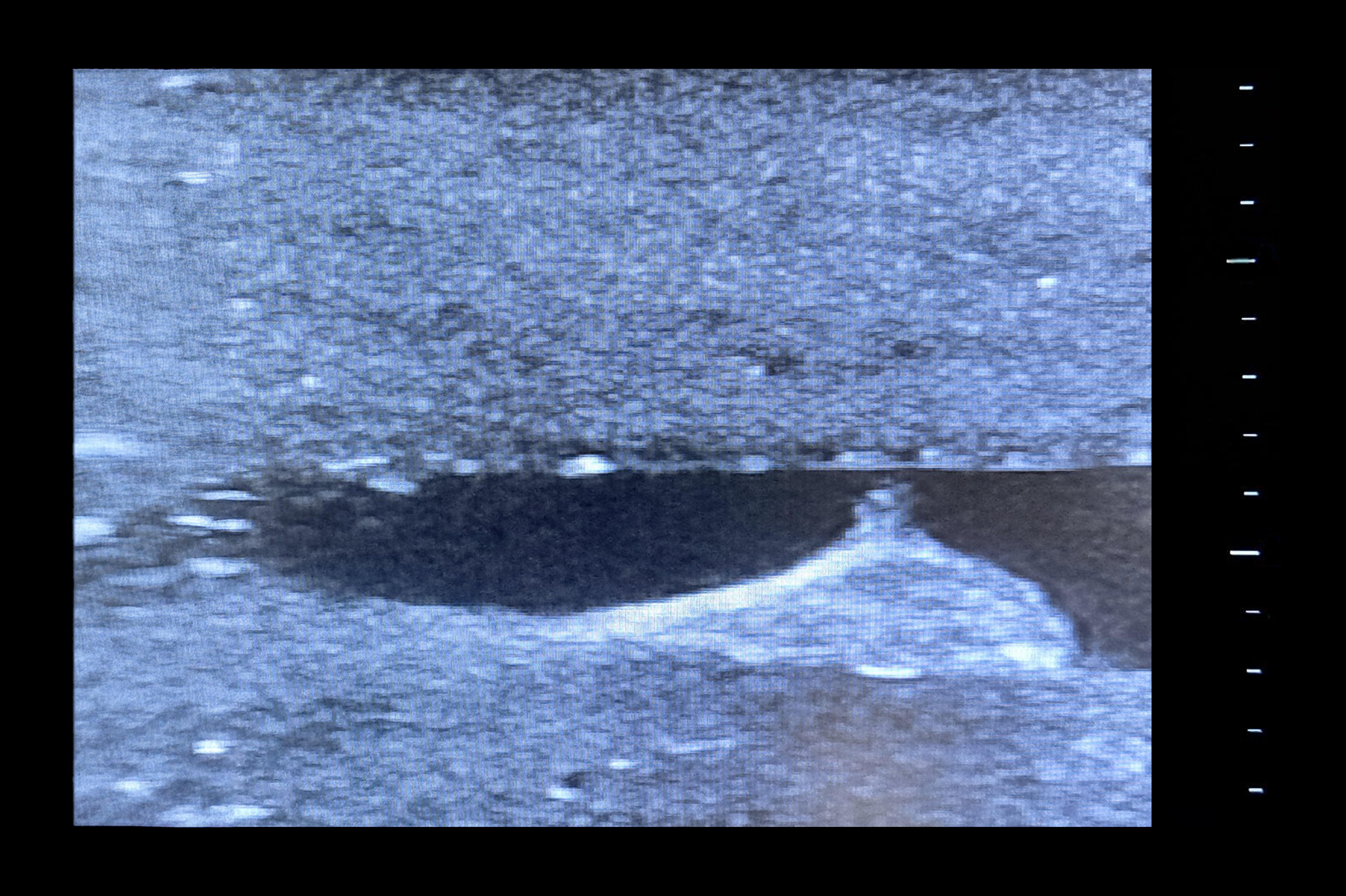 Central Access Ultrasound Simulator with Calcifications, Dark