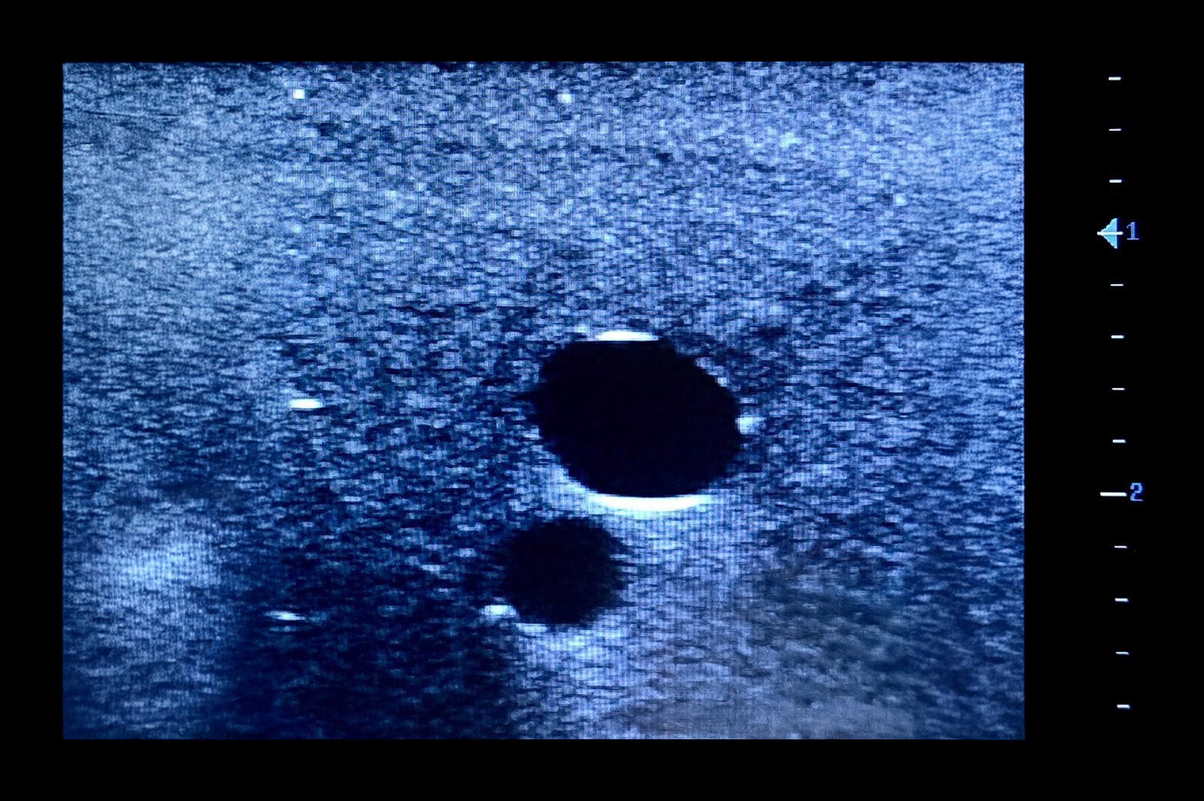 Femoral Access Ultrasound Simulator with Calcifications, Light