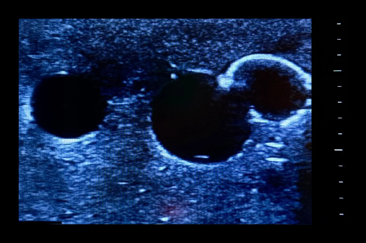 Femoral Access Ultrasound Simulator with Calcifications, Dark