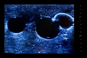 Femoral Access Ultrasound Simulator with Calcifications, Dark