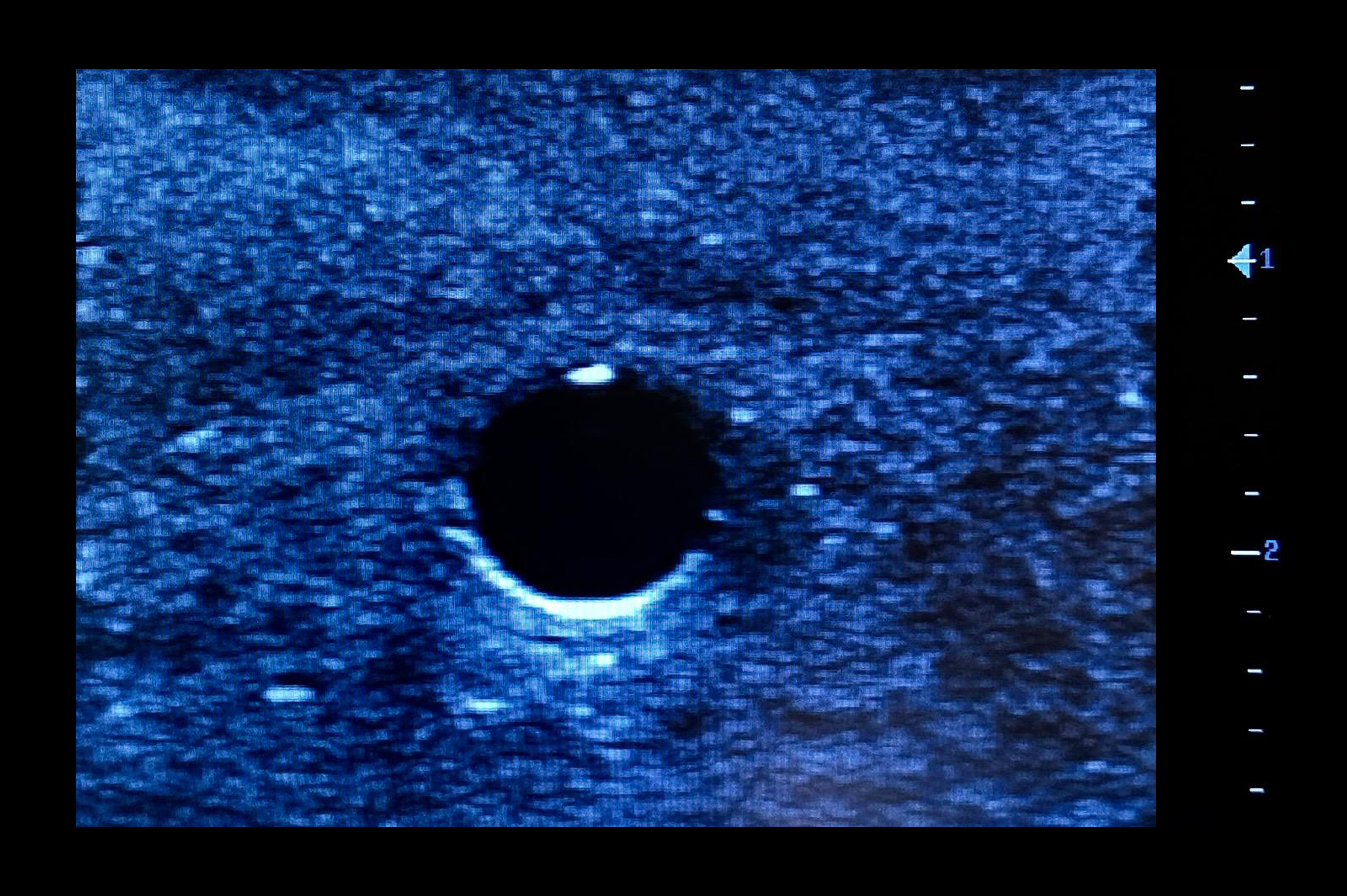 Femoral Access Ultrasound Simulator with Aneurysms, Dark