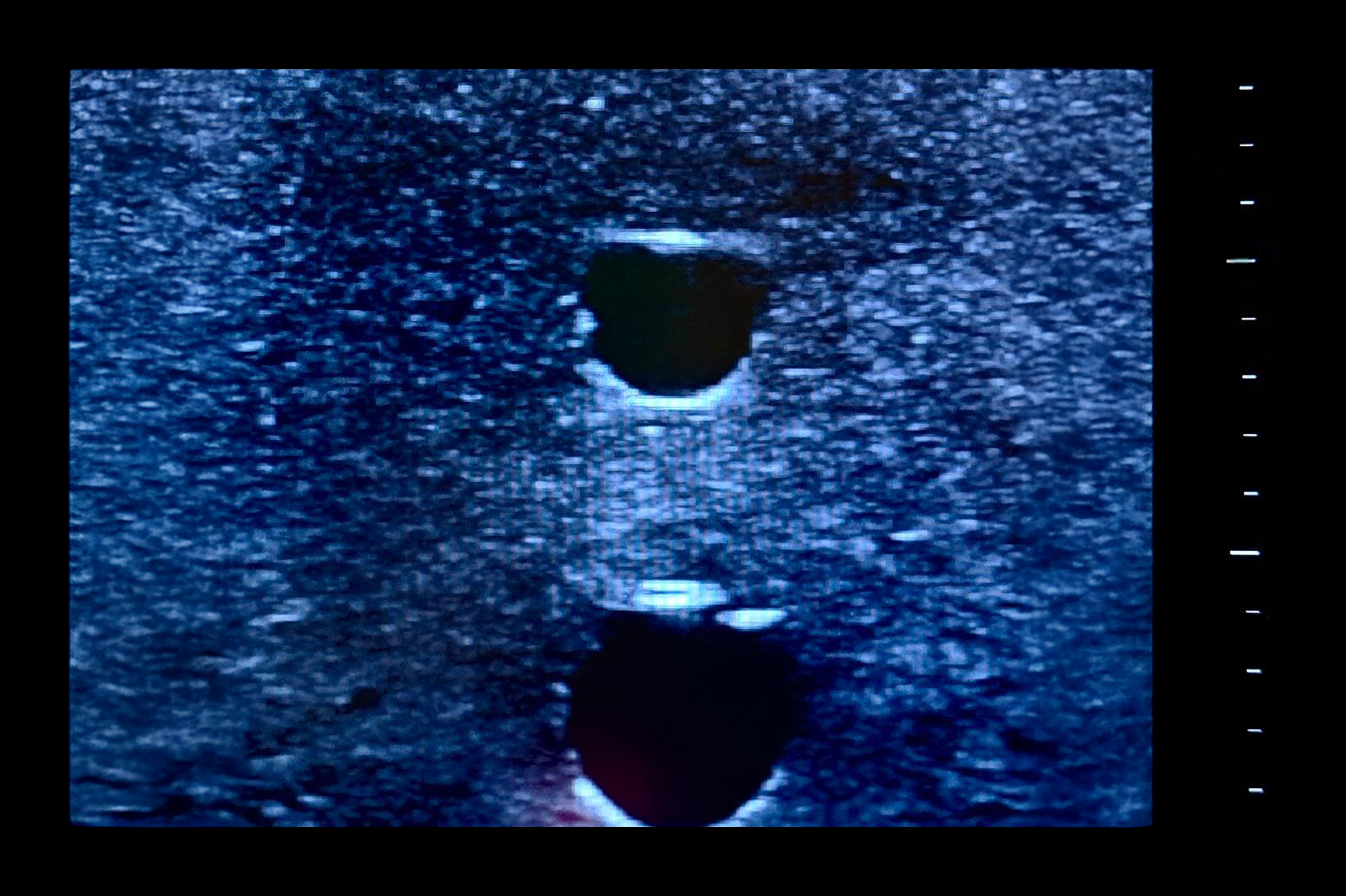 Ultrasound Simulator with 4 Central Lines, Light