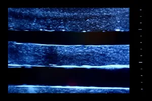 Ultrasound Simulator with 4 Central Lines, Light