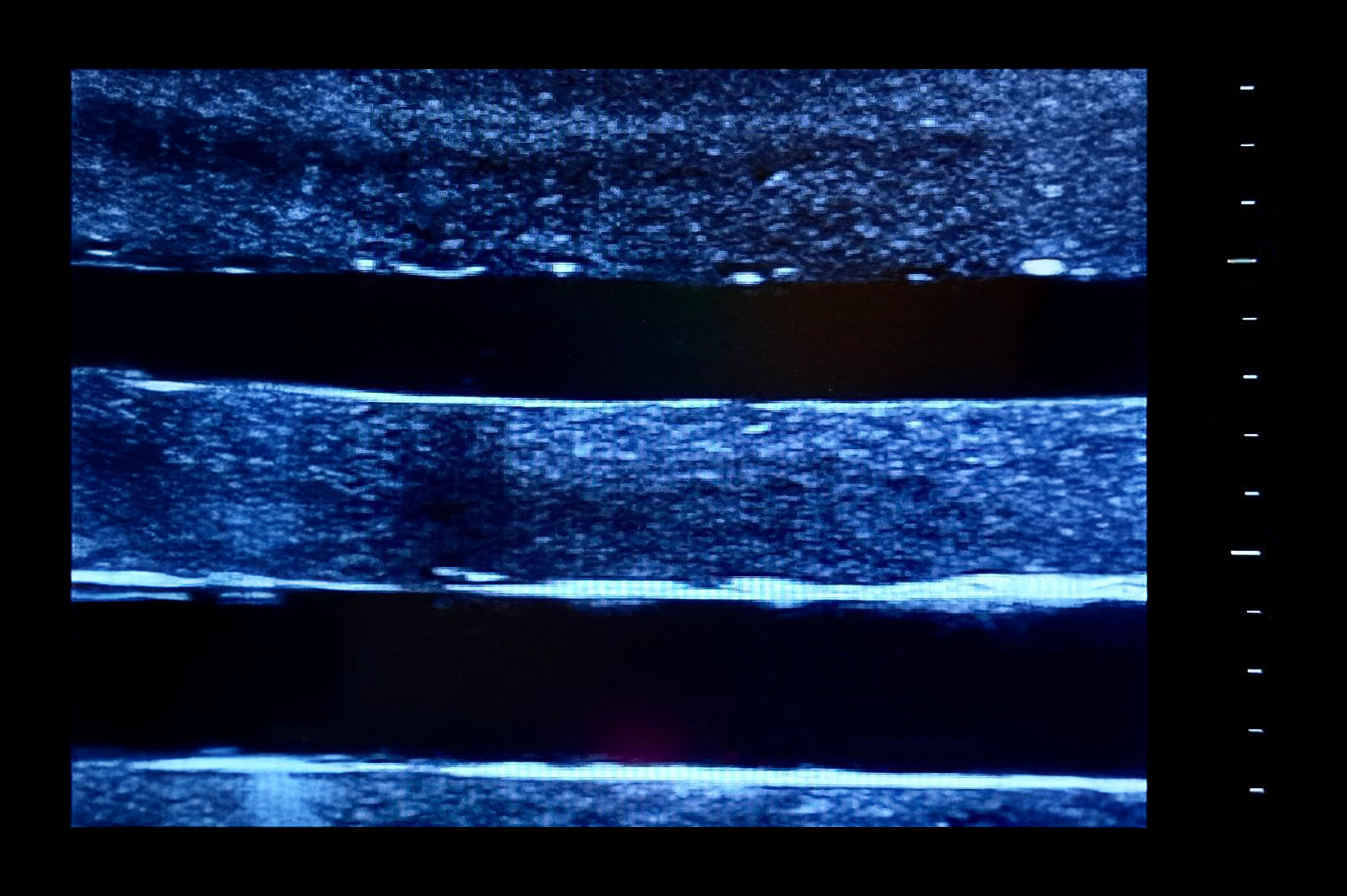Ultrasound Simulator with 4 Central Lines, Light