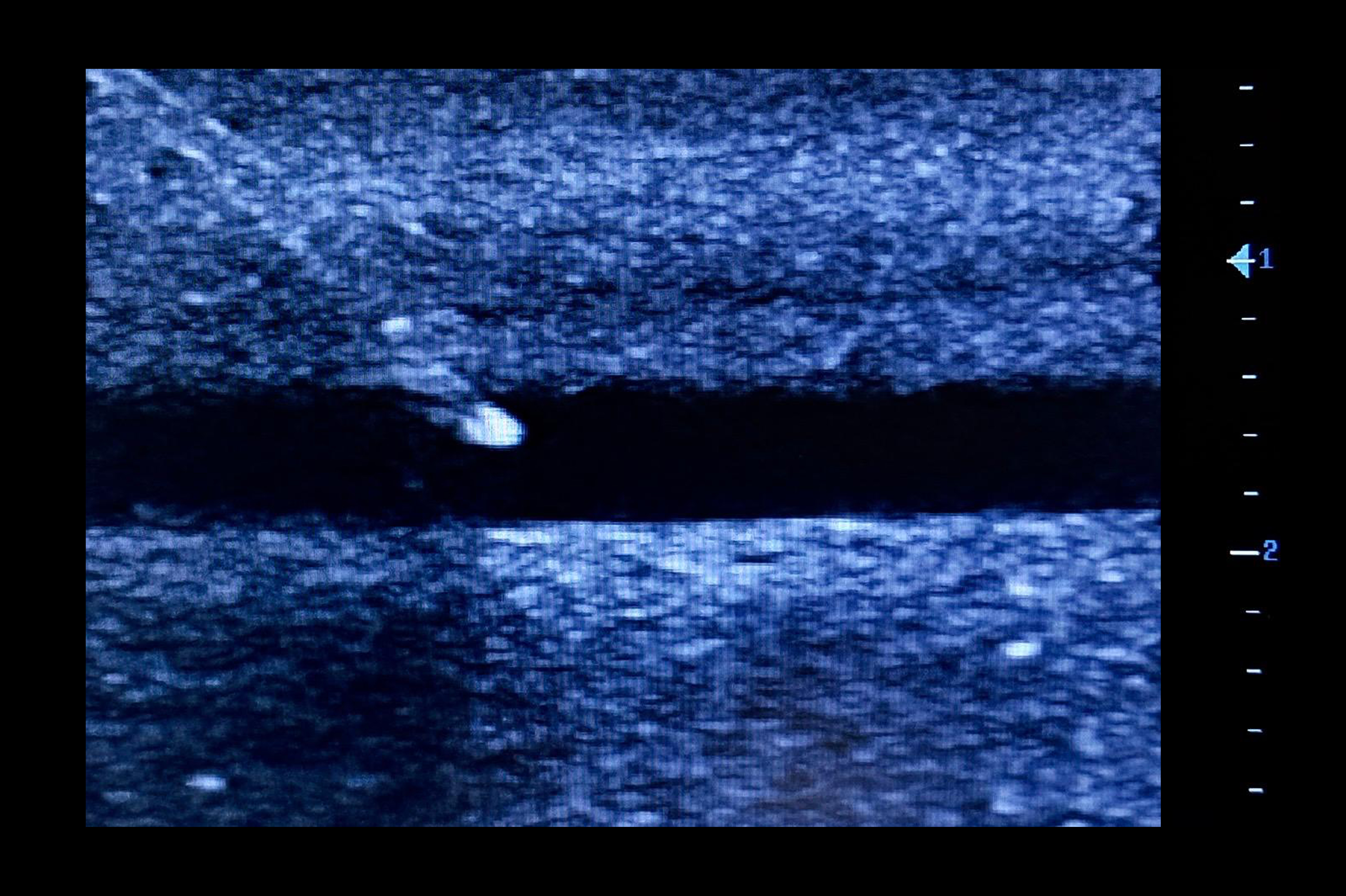 Ultrasound Simulator for Radial Artery Catheterisation, Light