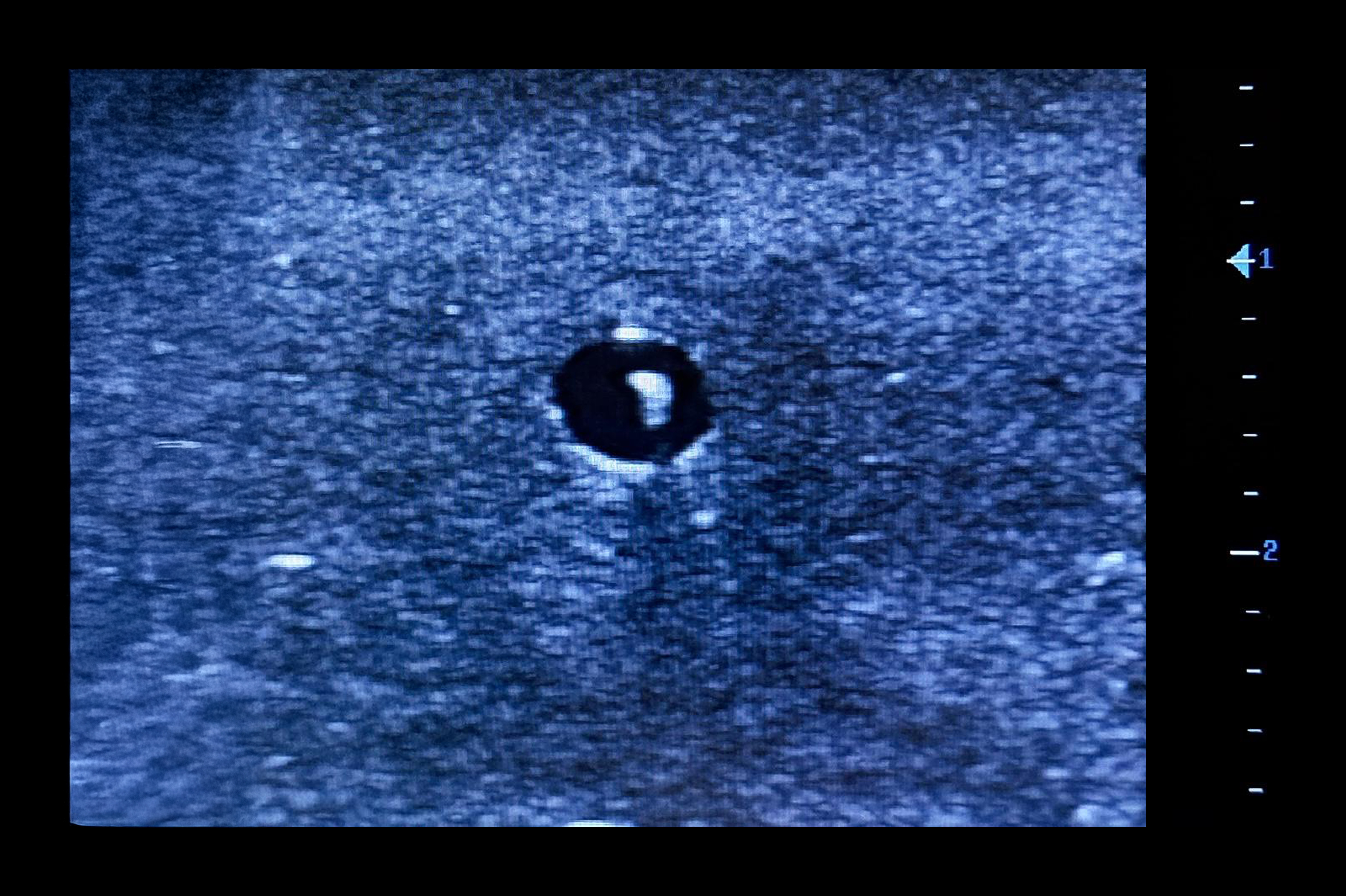 Ultrasound Simulator for Radial Artery Catheterisation, Dark