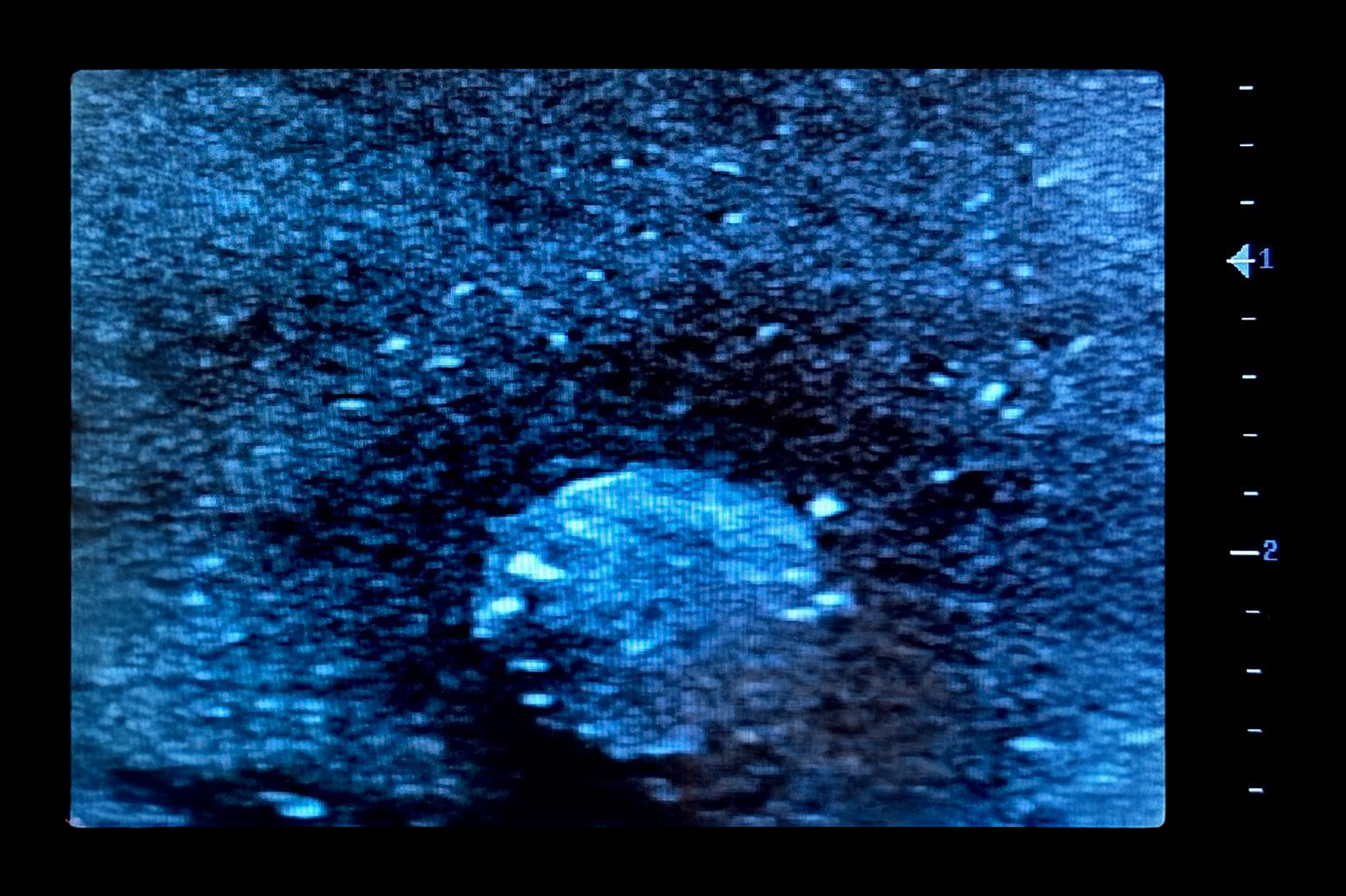 Ultrasound Simulator with Breast Pathologies/Biopsy, Dark