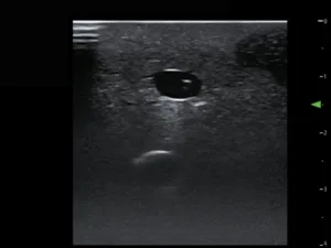 TruCVC®, Dark