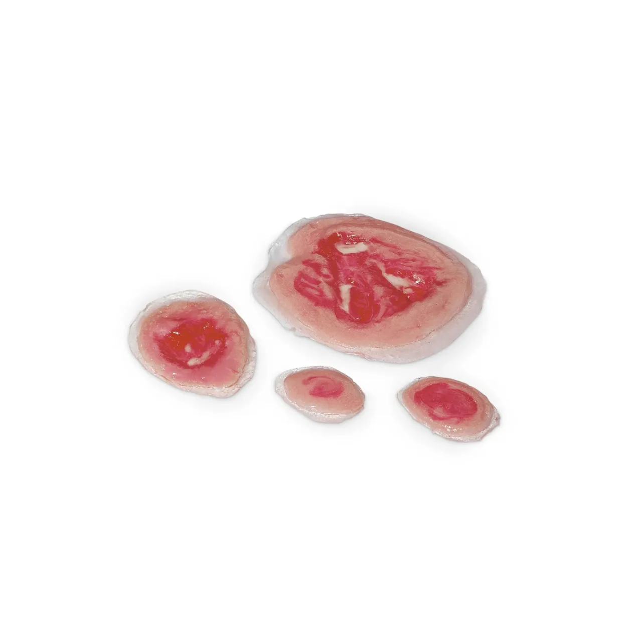 Wound - Pressure Ulcers