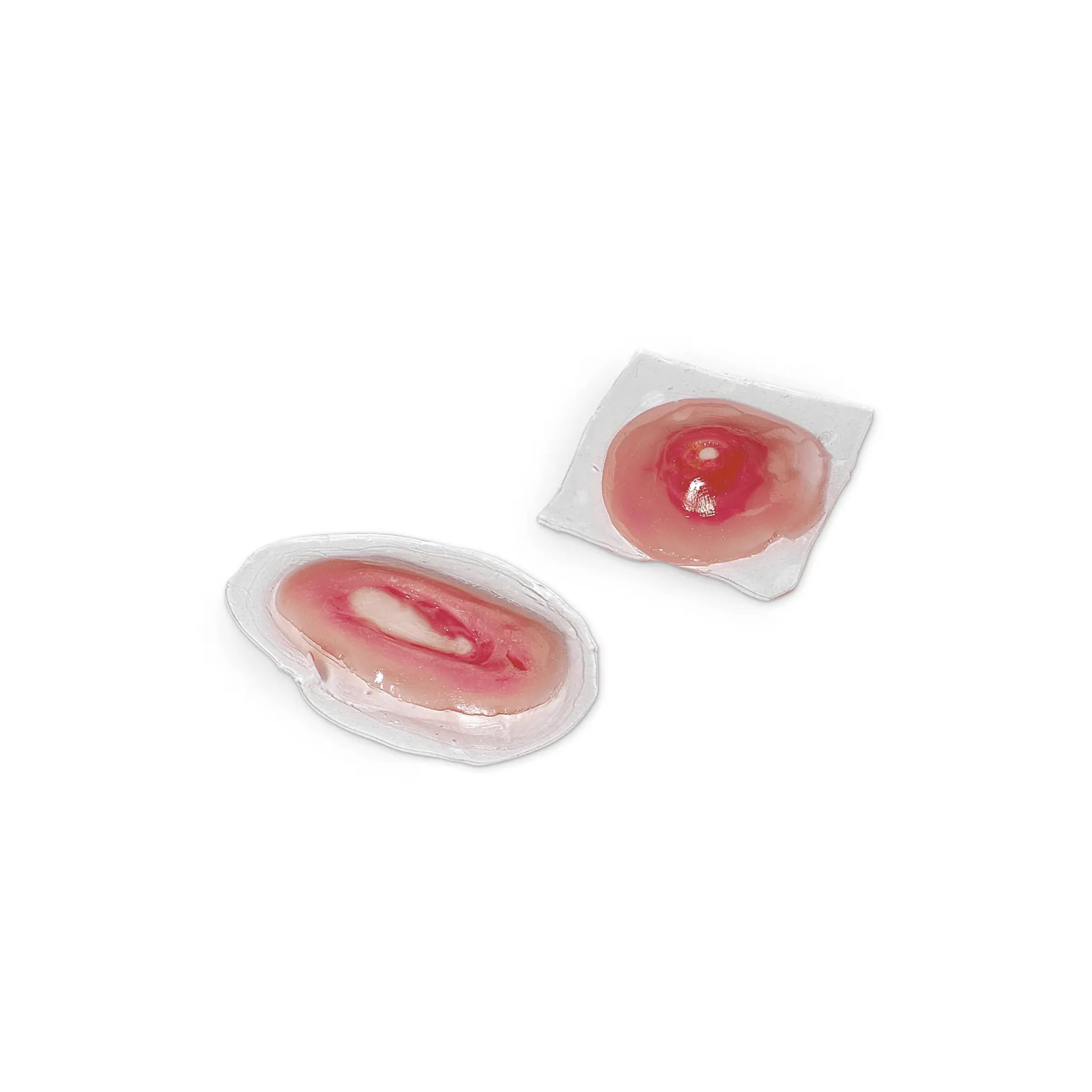 Cysts – Pilar and Sebaceous