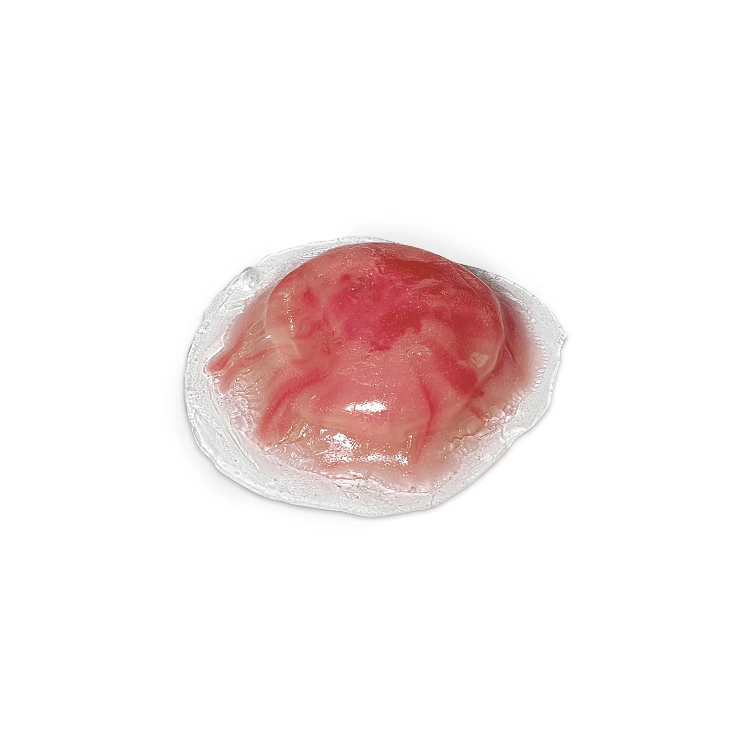 Infected Cyst — Pus-Filled