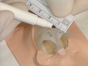 Rhinoplasty Model