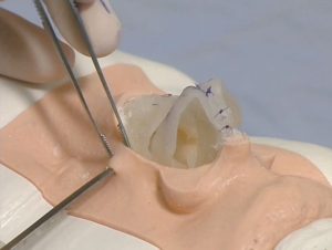 Rhinoplasty Model