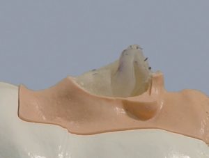 Rhinoplasty Model