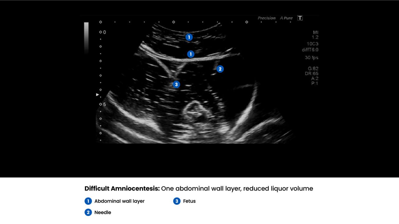 Amnio Abby® - Ultrasound Guided Invasive Procedures Simulator