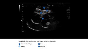 Amnio Abby® - Ultrasound Guided Invasive Procedures Simulator