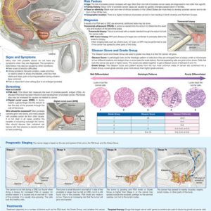 Understanding Prostate Cancer Chart