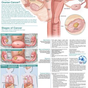 Understanding Ovarian Cancer Chart