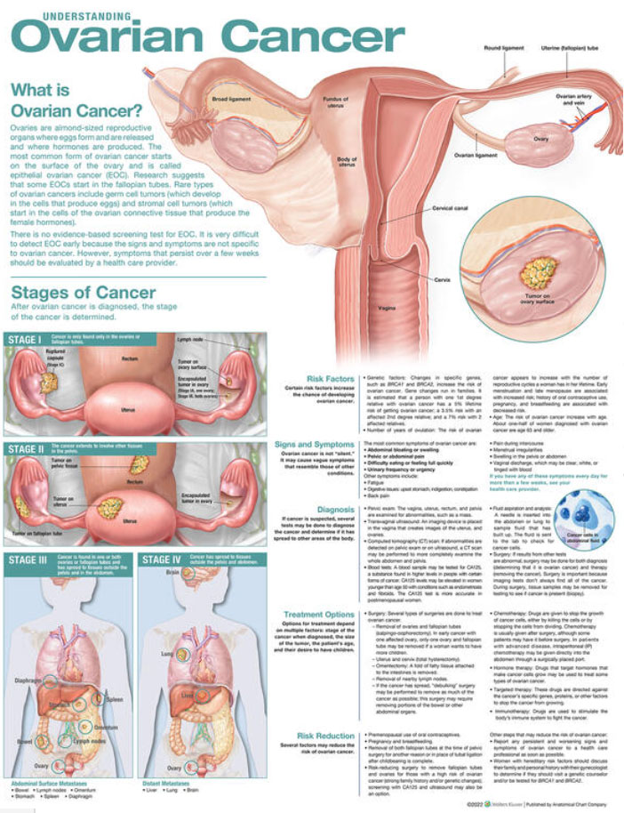 Understanding Ovarian Cancer Chart